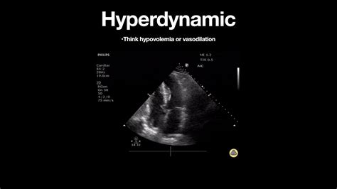 lv function is hyperdynamic